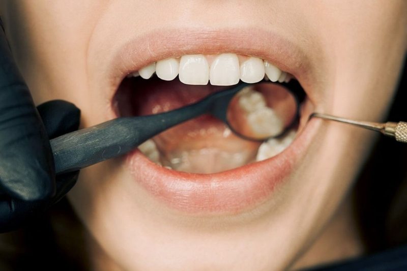 Acid Erosion How It Can Change the Shape, Strength, and Function of Your Teeth