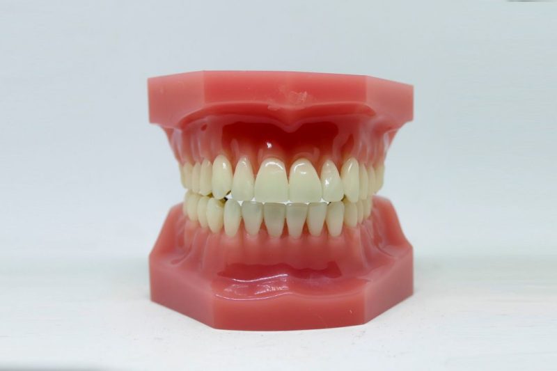 Occlusal evaluation of worn and restored teeth at Lagoon Dental in Titusville