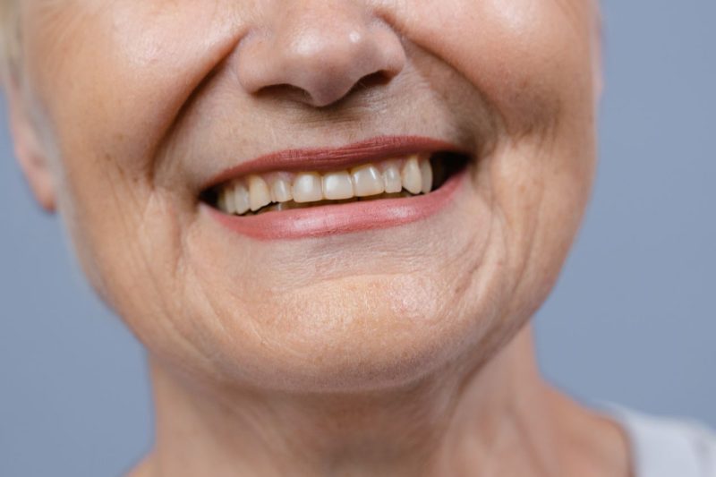 Worn front teeth evaluated for grinding and clenching at Lagoon Dental